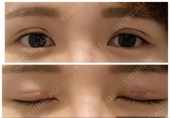 二重埋没 たにまちクリニック DAY 3 メイン用