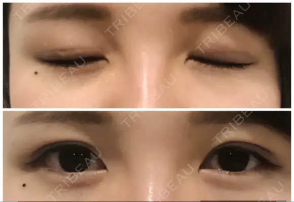 二重埋没 たにまちクリニック DAY 4 メイン用