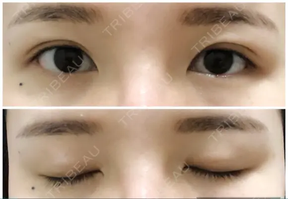 二重埋没 たにまちクリニック AFTER メイン用