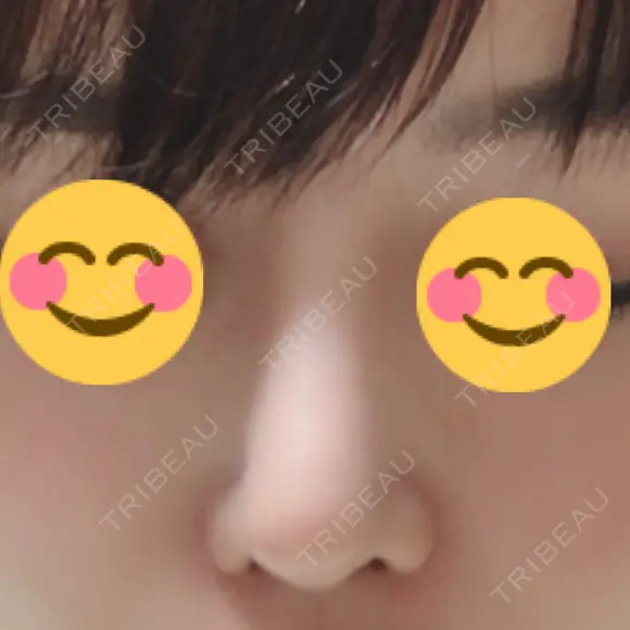 隆鼻術 / 鼻中隔延長（切開） View美容整形外科 AFTER メイン用