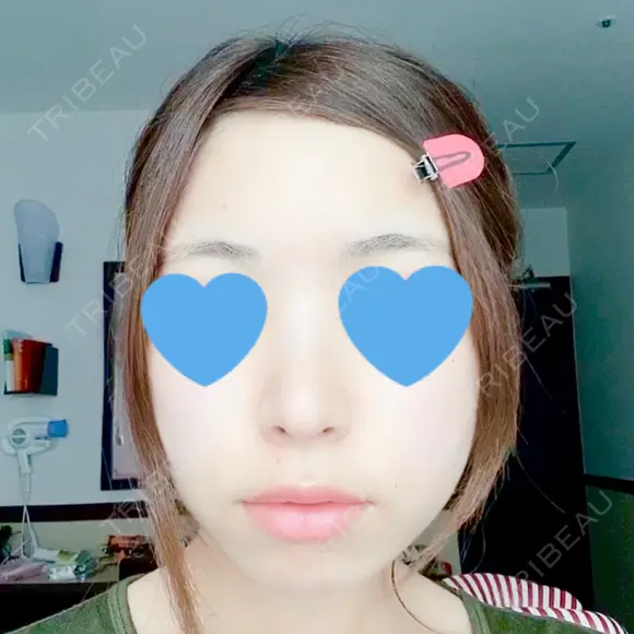 鼻中隔延長（切開） / 軟骨移植 / 鼻尖縮小 HANABI整形外科 DAY 96 メイン用
