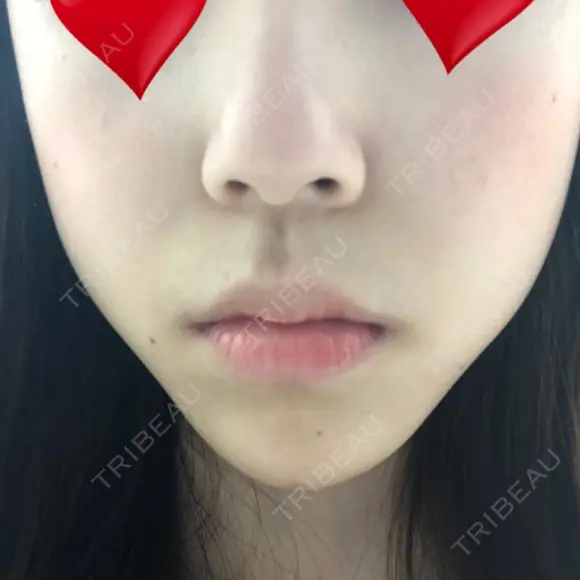 ヒアルロン酸注入（あご） 湘南美容クリニック 西宮北口院 DAY 1 メイン用