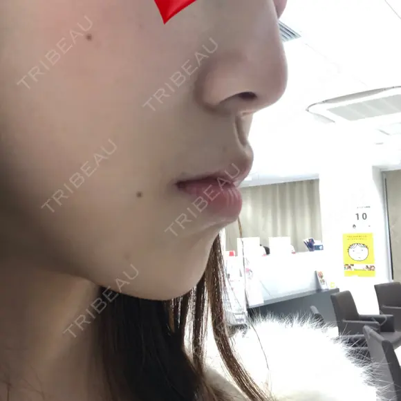 ヒアルロン酸注入（あご） 湘南美容クリニック 西宮北口院 DAY 1 メイン用