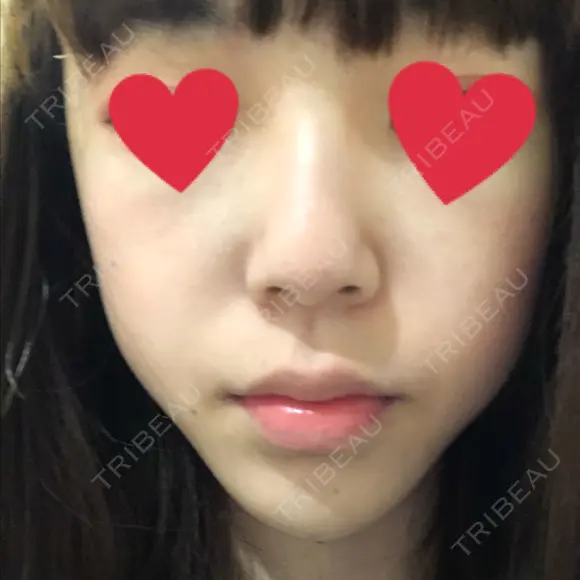 ヒアルロン酸注入（あご） 湘南美容クリニック 西宮北口院 DAY 2 メイン用