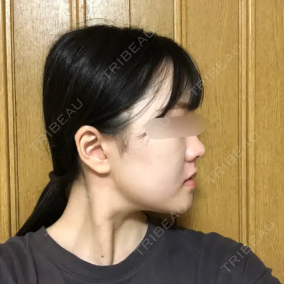 骨切り（あご） / 骨削り（エラ） / 骨削り（頬） RG整形外科（旧リオン整形外科） DAY 61 メイン用