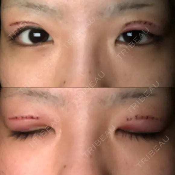 二重切開 / 上まぶたの脂肪取り TCB東京中央美容外科 江坂院 DAY 0 メイン用