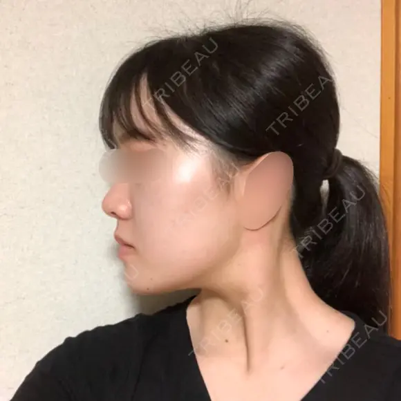 骨切り（あご） / 骨削り（エラ） / 骨削り（頬） RG整形外科（旧リオン整形外科） DAY 91 メイン用