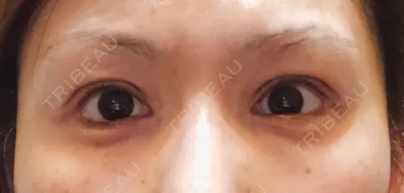 二重切開 / 眼瞼下垂（切開） / タレ目形成・グラマラスライン（切開） 湘南美容クリニック 辻堂アカデミア DAY 16 メイン用