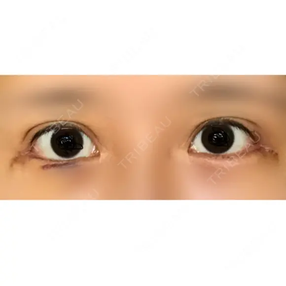 目尻切開 / 目尻靭帯移動 VARABON美容外科 DAY 10 メイン用