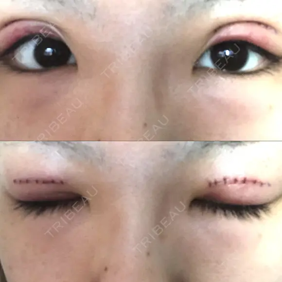 二重切開 / 上まぶたの脂肪取り TCB東京中央美容外科 江坂院 DAY 2 メイン用