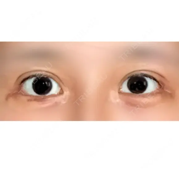 目尻切開 / 目尻靭帯移動 VARABON美容外科 DAY 14 メイン用