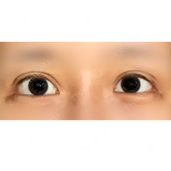 目尻切開 / 目尻靭帯移動 VARABON美容外科 DAY 35 メイン用