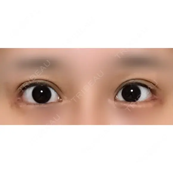 目尻切開 / 目尻靭帯移動 VARABON美容外科 AFTER メイン用