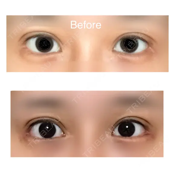 目尻切開 / 目尻靭帯移動 VARABON美容外科 DAY 64 メイン用