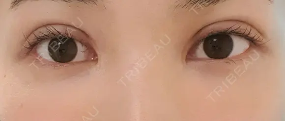 二重切開 CLASSY 仙台美容外科・美容皮膚科 DAY 28 メイン用