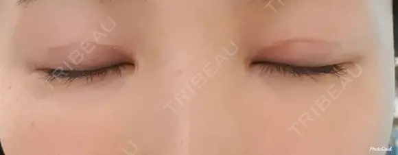 二重切開 CLASSY 仙台美容外科・美容皮膚科 DAY 28 メイン用