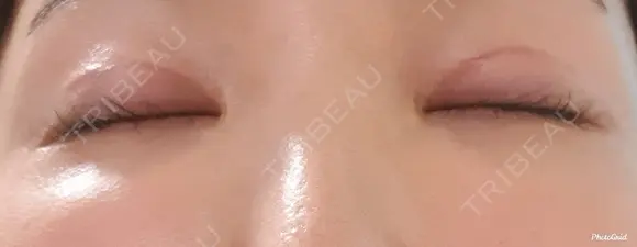 二重切開 CLASSY 仙台美容外科・美容皮膚科 DAY 28 メイン用