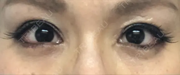 二重切開 / 眼瞼下垂（切開） / タレ目形成・グラマラスライン（切開） 湘南美容クリニック 辻堂アカデミア DAY 17 メイン用