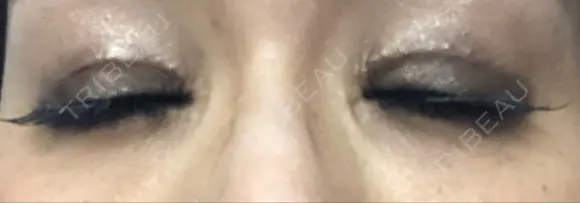 二重切開 / 眼瞼下垂（切開） / タレ目形成・グラマラスライン（切開） 湘南美容クリニック 辻堂アカデミア DAY 17 メイン用