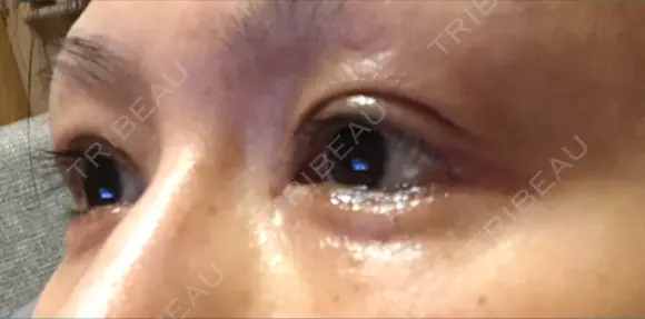 二重切開 / 眼瞼下垂（切開） / タレ目形成・グラマラスライン（切開） 湘南美容クリニック 辻堂アカデミア DAY 23 メイン用