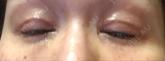 二重切開 / 眼瞼下垂（切開） / タレ目形成・グラマラスライン（切開） 湘南美容クリニック 辻堂アカデミア DAY 23 メイン用