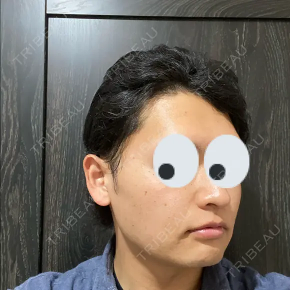 バッカルファット除去 / 脂肪吸引（顔） グロービー美容整形外科 DAY 80 メイン用