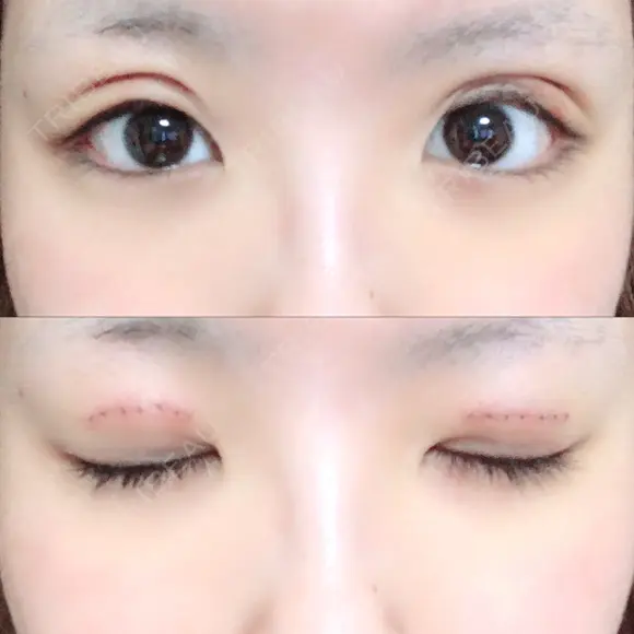 二重切開 / 上まぶたの脂肪取り TCB東京中央美容外科 江坂院 DAY 5 メイン用