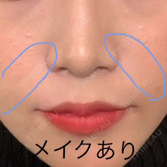 肌ヒアルロン酸注入（たるみ・シワ改善） / その他（肌） フィラークリニック 新宿院 DAY 1 メイン用