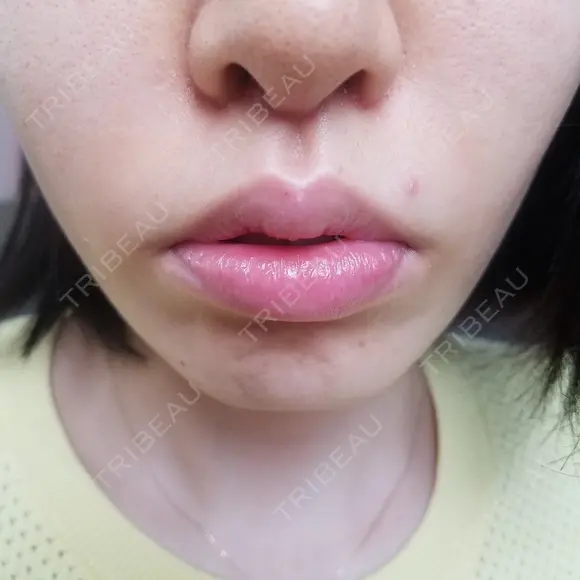 人中短縮 CLASSY 仙台美容外科・美容皮膚科 AFTER メイン用