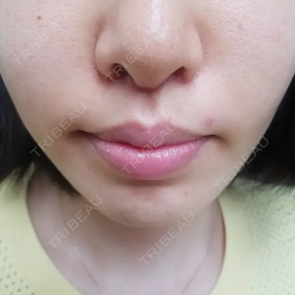 人中短縮 CLASSY 仙台美容外科・美容皮膚科 DAY 23 メイン用