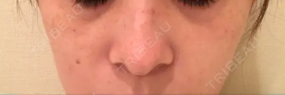 YAGレーザー 仁愛クリニック DAY 7 メイン用