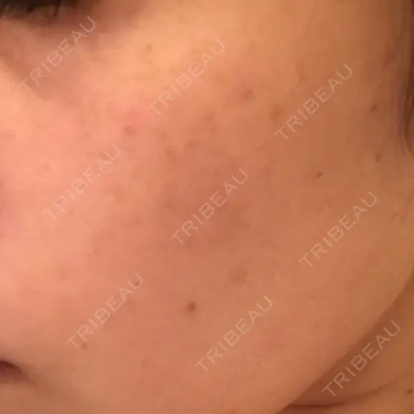 YAGレーザー 仁愛クリニック DAY 7 メイン用