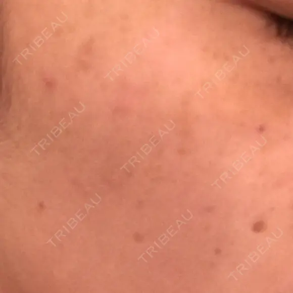 YAGレーザー 仁愛クリニック DAY 7 メイン用