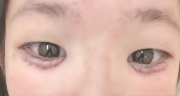 その他（目元） ばん皮膚科 DAY 0 メイン用