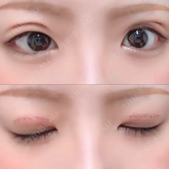 二重切開 / 上まぶたの脂肪取り TCB東京中央美容外科 江坂院 DAY 7 メイン用