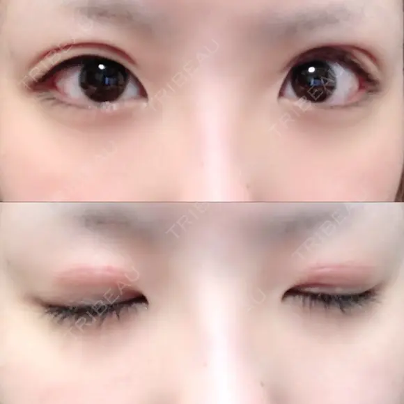 二重切開 / 上まぶたの脂肪取り TCB東京中央美容外科 江坂院 DAY 7 メイン用