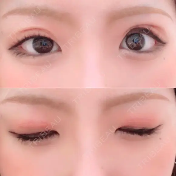 二重切開 / 上まぶたの脂肪取り TCB東京中央美容外科 江坂院 DAY 7 メイン用