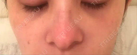 YAGレーザー 仁愛クリニック DAY 7 メイン用