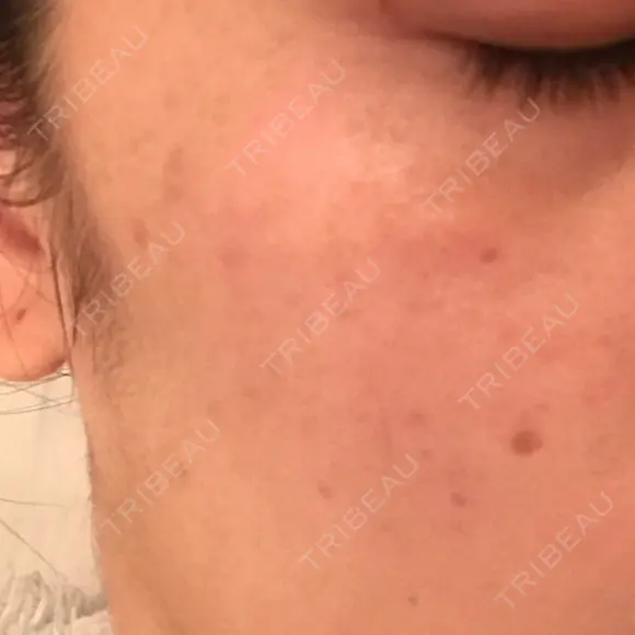 YAGレーザー 仁愛クリニック DAY 7 メイン用