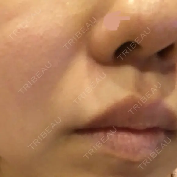 ほくろ・いぼ切除（肌） Mスキンクリニック AFTER メイン用