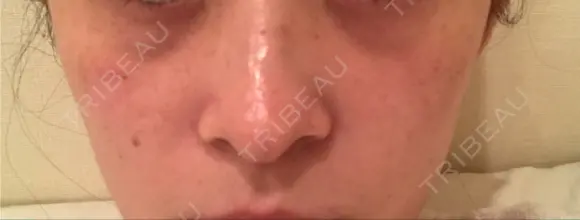 YAGレーザー 仁愛クリニック AFTER メイン用