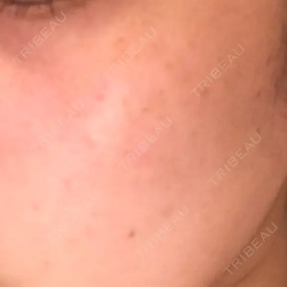 YAGレーザー 仁愛クリニック DAY 8 メイン用