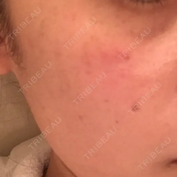 YAGレーザー 仁愛クリニック DAY 8 メイン用