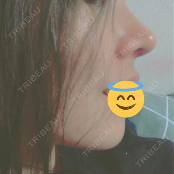 隆鼻術 / 鼻尖形成（切開） / 鼻中隔延長（切開） / 眉間プロテーゼ FROM B整形外科 (旧バウム整形外科) AFTER メイン用