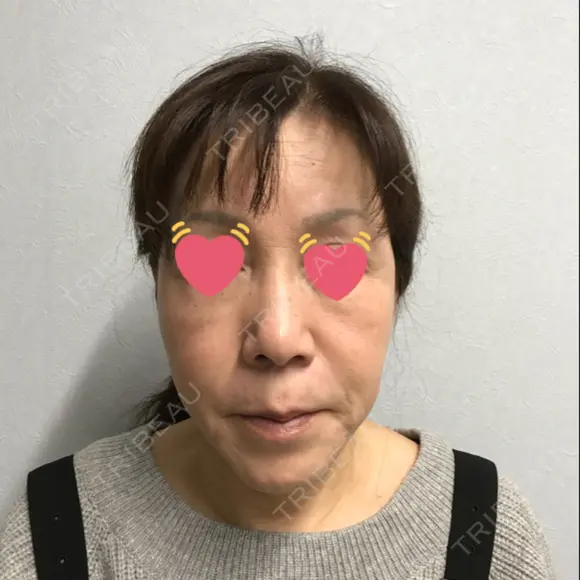 肌ヒアルロン酸注入（たるみ・シワ改善） ジョウクリニック 姫路院 AFTER メイン用