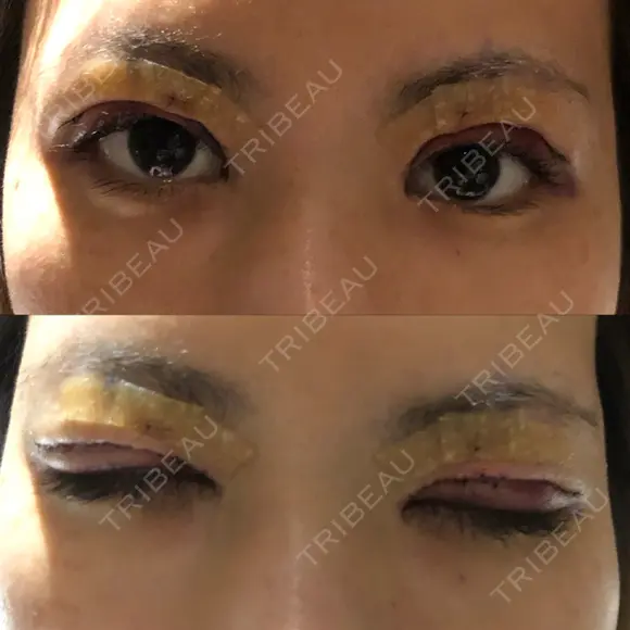 二重切開 / その他（目元） RG整形外科（旧リオン整形外科） DAY 0 メイン用