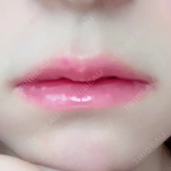 口唇縮小術 / PRP皮膚再生療法 品川美容外科 品川院 AFTER メイン用