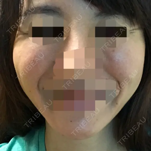 脂肪溶解注射（顔） ヴェリテクリニック 名古屋院 DAY 29 メイン用