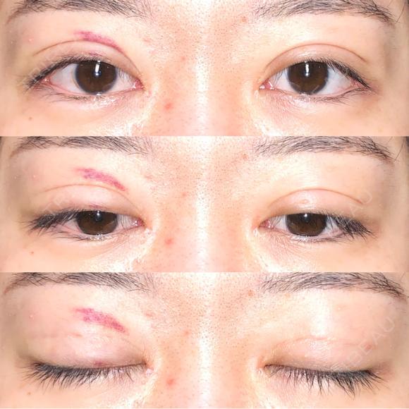 眼瞼下垂（切開） / その他（目元） / 目尻切開 / 自然癒着法 POP美容整形クリニック DAY 27 メイン用