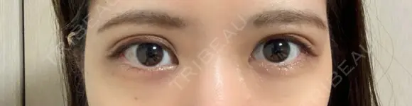 二重埋没 あきこクリニック DAY 28 メイン用